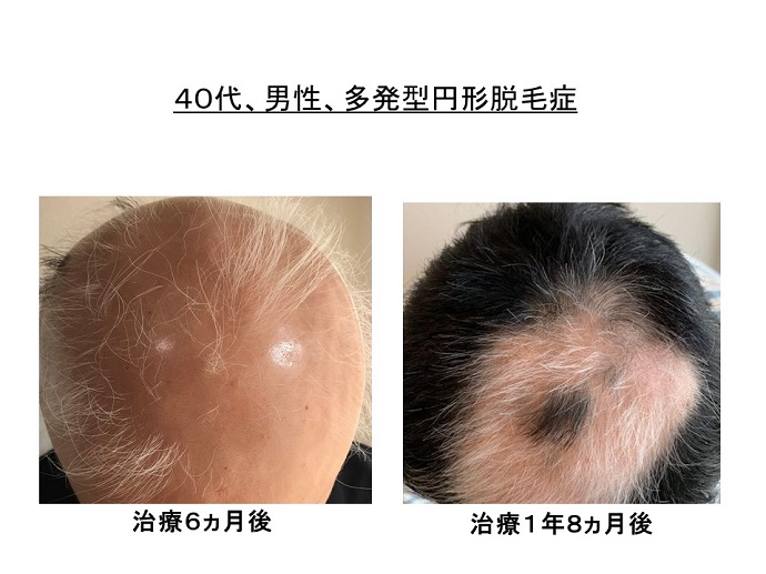 円形脱毛症　病院